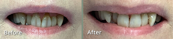 Before and After Smile Revitalization