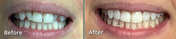 Before and After Smile Revitalization