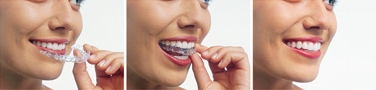 Invisalign Aligners