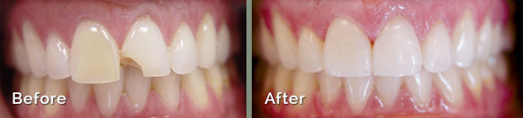 Before and After Porcelain Veneers